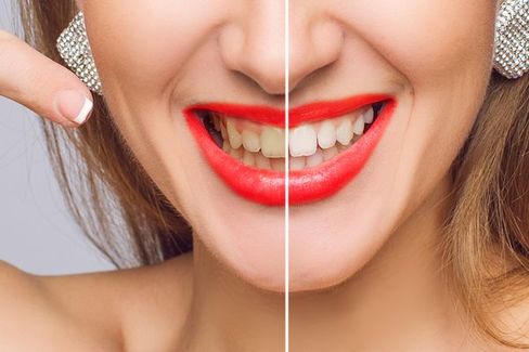 Before and after teeth whitening